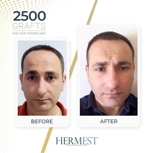 Image of Hermest Hair Transplant Gallery 3