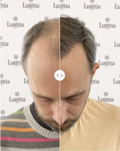 Image of Before and After Hair Transplantation