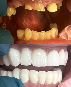 Image of Smile Makeover - Implant House Albania