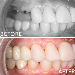 Image of Dental implants