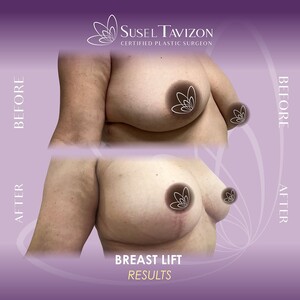 Image of Breast Lift