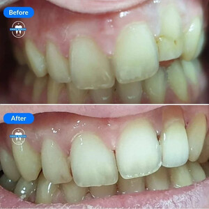 Image of Before and After Dental Care