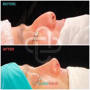 Image of Rhinoplasty before and after