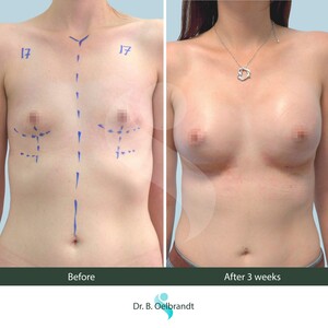 Image of Breast Implant - Singelberg Clinic