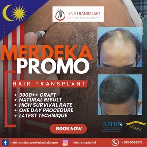 Image of Hair Transplant Kuala Lumpur Gallery 3