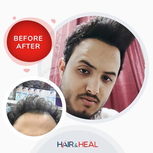 Image of Before and after hair transplant