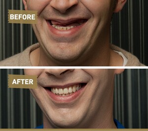 Image of Dental implants