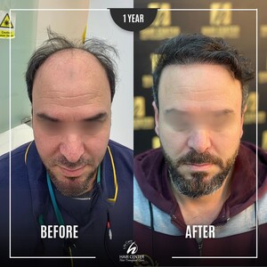 Image of Before and After a Hair Transplant