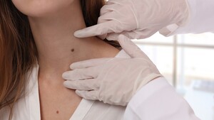 Image of Mole Assessment - Dermatology Clinic