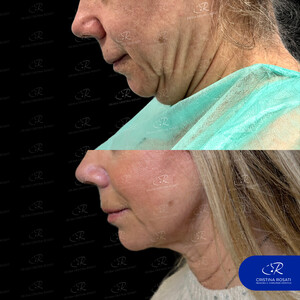 Image of Neck lift