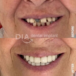 Image of Dental implant Antalia Gallery 1