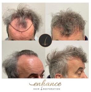 Image of Enhance Hair Restoration Gallery 2