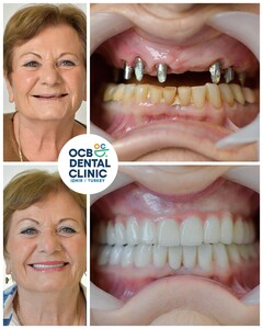 Image of Dental implants