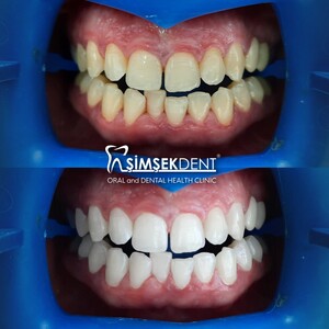 Image of Teeth cleaning - Şimşek Dent