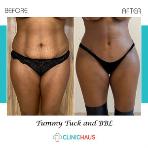 Image of Tummy Tuck and BBL