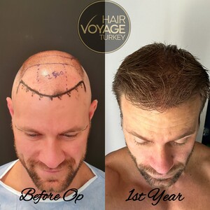 Image of Hair Voyage Turkey Gallery 0