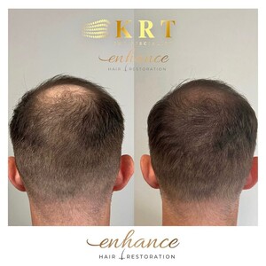 Image of Enhance Hair Restoration Gallery 1