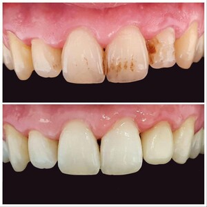 Image of Teeth whitening