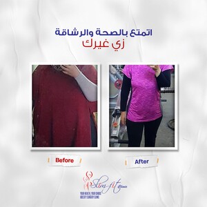 Image of Gastric bypass - Dr. Hany Armia
