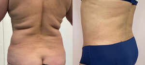 Image of Liposuction