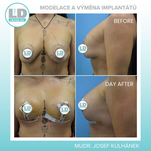 Image of Breast Implants -  LD Clinic Prague