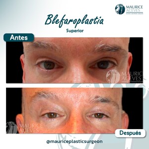 Image of Eyelid surgery before and after procedure