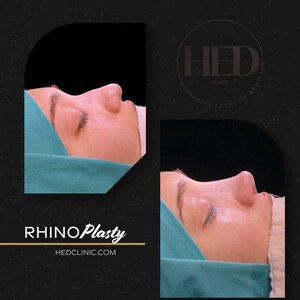 Image of Rhinoplasty