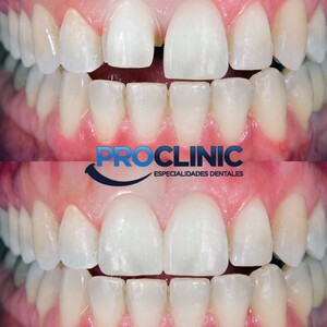 Image of E-Max Dental Veneer