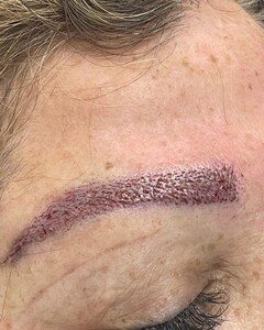 Image of Eyebrow transplant