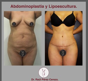 Image of Tummy tuck