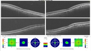 Image of Retinal Detachment Surgery AFTER