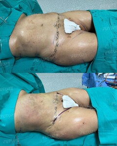 Image of Tummy Tuck - Future Clinic 