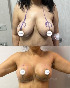 Image of Breast Lifting with Implants - Future Clinic Turkey