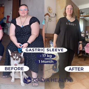 Image of Gastric sleeve