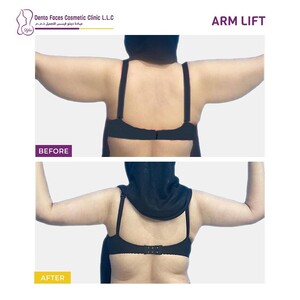 Image of Before and After Arm Lift