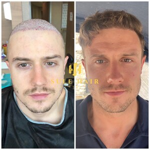 Image of Sule Hair Transplant Gallery 2