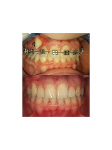 Image of Braces - Dentelli