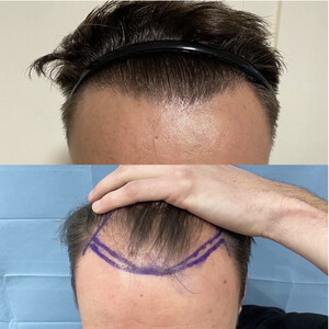 Image of Before and After Hair Transplantation