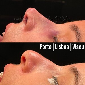 Image of Rhinoplasty in Porto