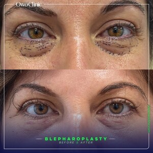 Image of Eyelid surgery