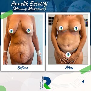 Image of Dr Remzi Fırıncıoğulları Mommy Makeover