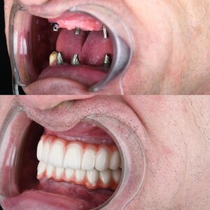 Image of Dental Implants - Dr Colic Dental Clinic