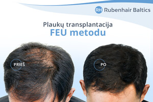 Image of FUE method -  Rubenhair