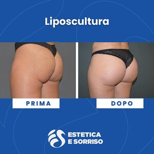 Image of Liposculpture - Estetica e Sorriso