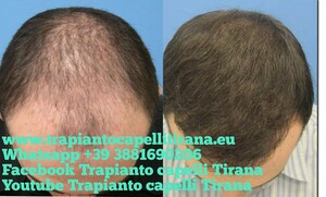 Image of Trapianto capelli Tirana Gallery 0