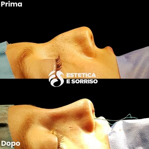 Image of Rhinoplasty - Estetica e Sorriso