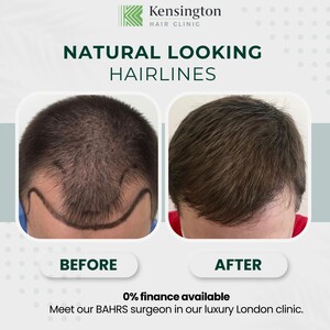 Image of Hair transplant