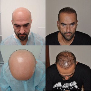 Image of Before and After Hair Transplantation