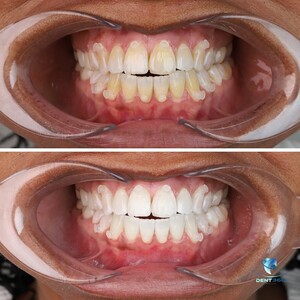 Image of Dental treatment before and after