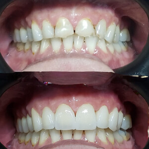 Image of E-max crowns